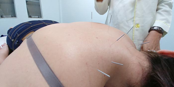 Depressão, síndrome do pânico e LER: acupuntura é cada vez mais procurada no Amapá