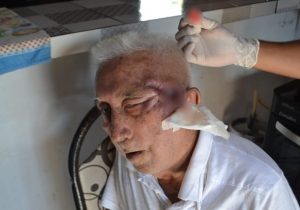 Idoso tem rosto consumido por câncer enquanto espera cirurgia