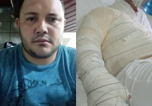 Homem é queimado com óleo e soda cáustica pela ex, afirma família