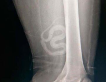 Baleado tinha cobra dentro da roupa