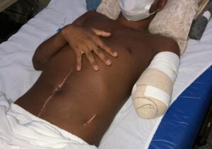 Por ciúmes: jovem tem braço amputado após ser atacado enquanto dormia