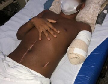 Por ciúmes: jovem tem braço amputado após ser atacado enquanto dormia