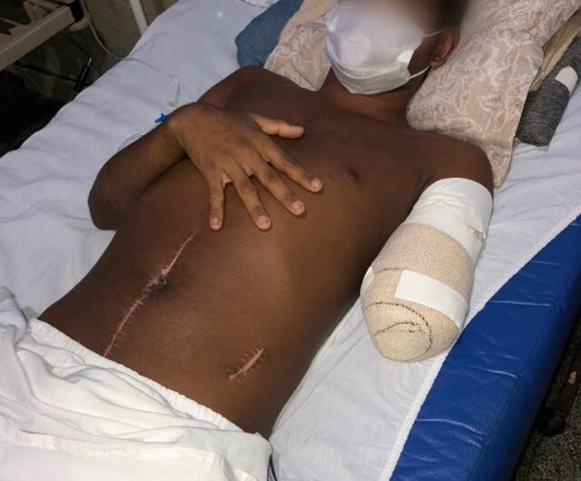 Por ciúmes: jovem tem braço amputado após ser atacado enquanto dormia