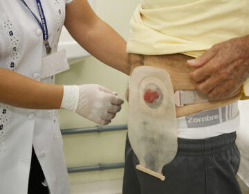 Ostomizados: Lucas anuncia R$ 1 milhão para cirurgias de reversão no Amapá