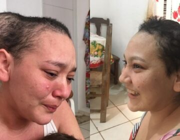 “Parecia duas cabeças”, diz jovem que teve inchaço drenado após doações de internautas
