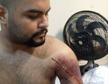 Dançarino atropelado em lanchonete pode perder o braço