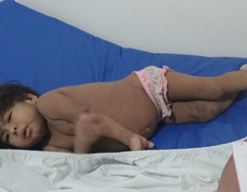 Família busca ajuda para criança com coceira extrema e problemas no fígado