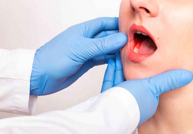 Sexo oral está entre os fatores de risco para o câncer de boca, alerta médico