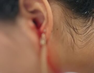 Jovem precisa de 4 doações de sangue por dia para compensar hemorragia