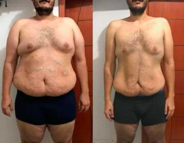 Cirurgia reparadora pós-bariátrica: planos têm a obrigação de garantir