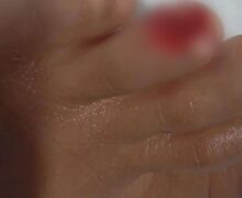 Piranha arranca pedaço do dedo de criança em ataque