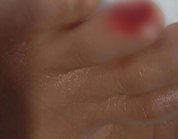 Piranha arranca pedaço do dedo de criança em ataque
