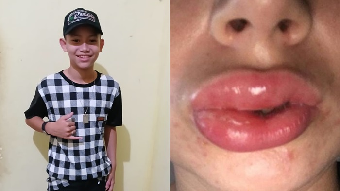 Mãe busca ajuda para realizar exames de filho com inchaço na boca e alergias pelo corpo