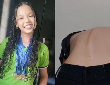 Mãe busca ajuda para estudante dedicada que sofre com dores e deformação na coluna