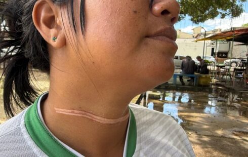 No caminho do trabalho, mulher é quase decapitada por fio elétrico