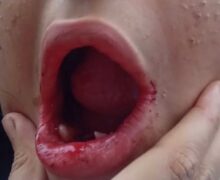Sob sedação, jovem autista tem 17 dentes extraídos sem autorização da família