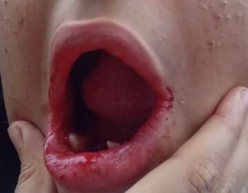 Sob sedação, jovem autista tem 17 dentes extraídos sem autorização da família