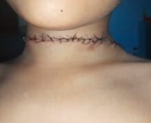 Menino leva 20 pontos após quase ser degolado por linha de pipa quando andava de bicicleta