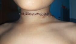 Menino leva 20 pontos após quase ser degolado por linha de pipa quando andava de bicicleta