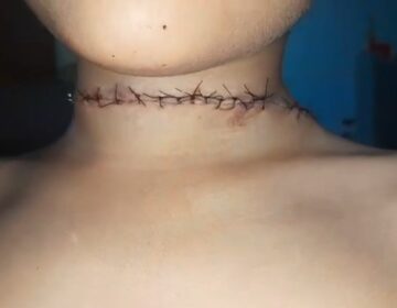 Menino leva 20 pontos após quase ser degolado por linha de pipa quando andava de bicicleta