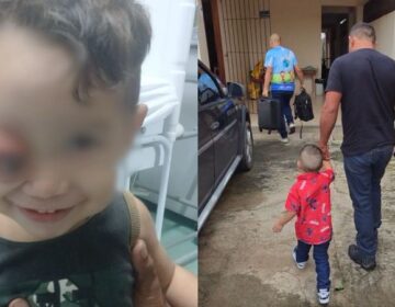 Câncer faz olho de menino de 2 anos saltar do rosto; ONG consegue tratamento em SP